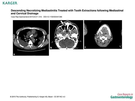 Descending Necrotizing Mediastinitis Treated with Tooth Extractions following Mediastinal and Cervical Drainage Case Rep Gastroenterol 2015;9:311-316 -