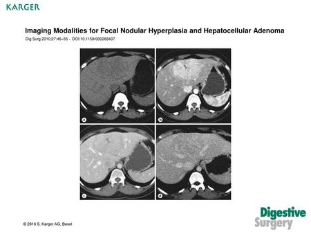 Imaging Modalities for Focal Nodular Hyperplasia and Hepatocellular Adenoma Dig Surg 2010;27:46–55 - DOI:10.1159/000268407 © 2010 S. Karger AG, Basel.