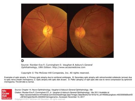 Examples of optic atrophy