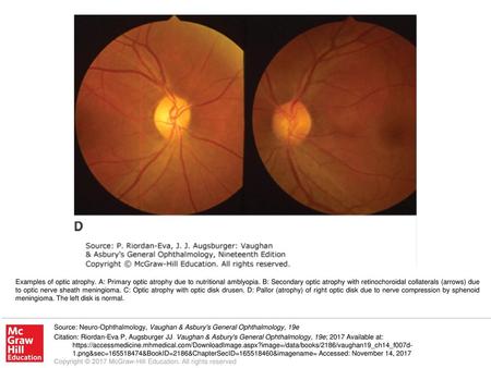 Examples of optic atrophy