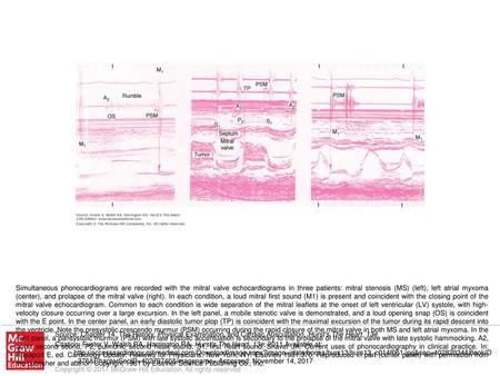 Simultaneous phonocardiograms are recorded with the mitral valve echocardiograms in three patients: mitral stenosis (MS) (left), left atrial myxoma (center),