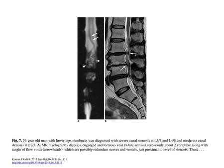 Fig. 7. 76-year-old man with lower legs numbness was diagnosed with severe canal stenosis at L3/4 and L4/5 and moderate canal stenosis at L2/3. A. MR myelography.