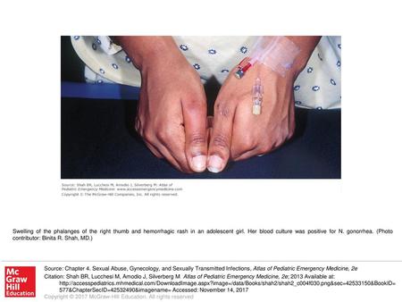 Swelling of the phalanges of the right thumb and hemorrhagic rash in an adolescent girl. Her blood culture was positive for N. gonorrhea. (Photo contributor: