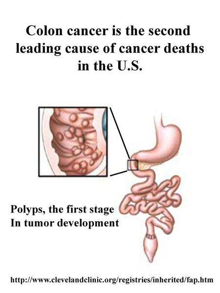 Colon cancer is the second leading cause of cancer deaths