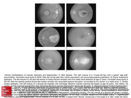 Clinical manifestations of macular dystrophy and degeneration