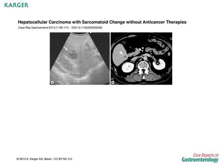 Case Rep Gastroenterol 2013;7: DOI: /