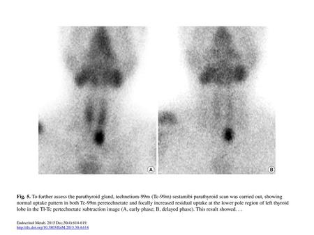 Fig. 5. To further assess the parathyroid gland, technetium-99m (Tc-99m) sestamibi parathyroid scan was carried out, showing normal uptake pattern in both.