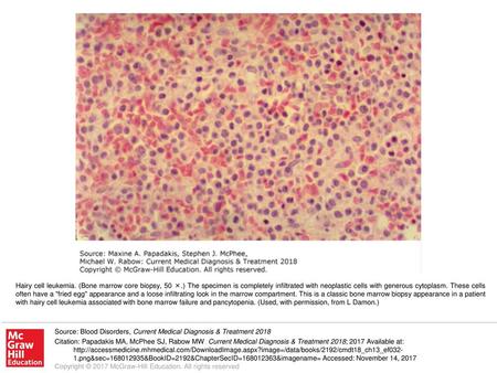 Hairy cell leukemia. (Bone marrow core biopsy, 50 ×