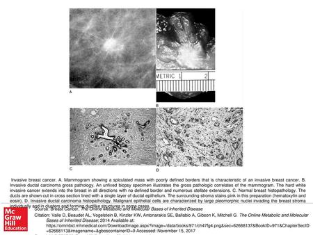 Invasive breast cancer. A