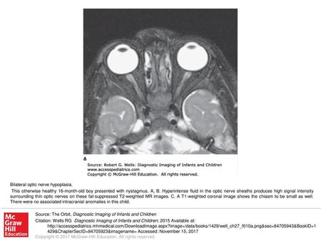 This otherwise healthy 16-month-old boy presented with nystagmus. A, B