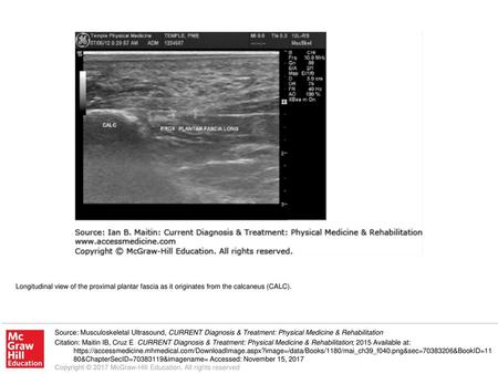 Longitudinal view of the proximal plantar fascia as it originates from the calcaneus (CALC). Source: Musculoskeletal Ultrasound, CURRENT Diagnosis & Treatment: