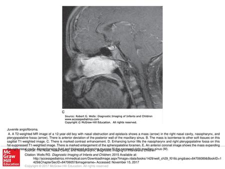 A. A T2-weighted MR image of a 12-year-old boy with nasal obstruction and epistaxis shows a mass (arrow) in the right nasal cavity, nasopharynx, and pterygopalatine.