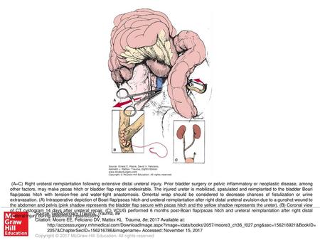 (A–C) Right ureteral reimplantation following extensive distal ureteral injury. Prior bladder surgery or pelvic inflammatory or neoplastic disease, among.