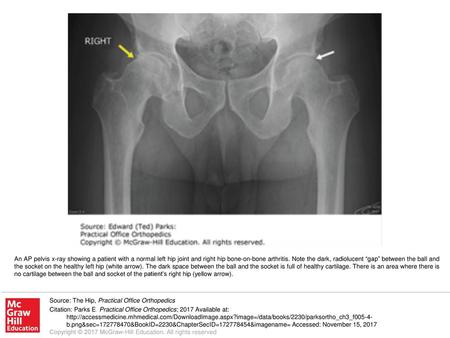 An AP pelvis x-ray showing a patient with a normal left hip joint and right hip bone-on-bone arthritis. Note the dark, radiolucent “gap” between the ball.