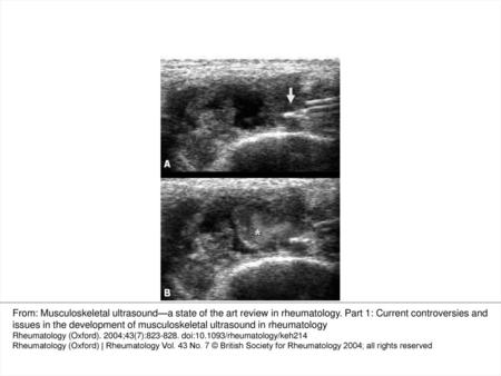 Fig. 1. Sonographic-guided injection of steroid in the metacarpophalangeal joint of a patient with rheumatoid arthritis (8–16 MHz linear transducer, Diasus,