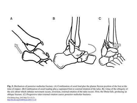 Fig. 3. Mechanism of posterior malleolar fracture