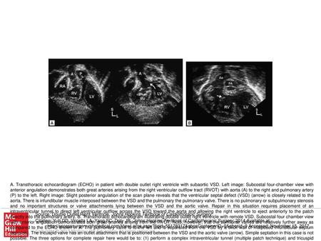 A. Transthoracic echocardiogram (ECHO) in patient with double outlet right ventricle with subaortic VSD. Left image: Subcostal four-chamber view with anterior.