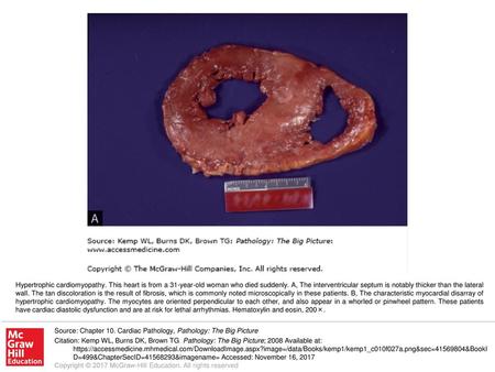 Hypertrophic cardiomyopathy