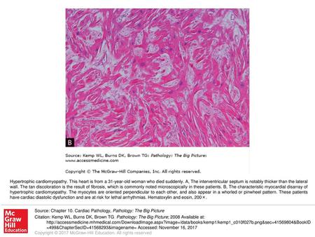 Hypertrophic cardiomyopathy