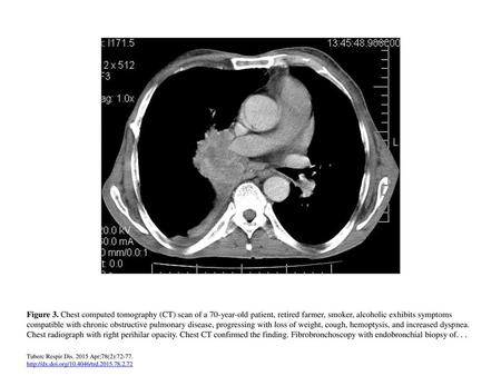 Figure 3. Chest computed tomography (CT) scan of a 70-year-old patient, retired farmer, smoker, alcoholic exhibits symptoms compatible with chronic obstructive.