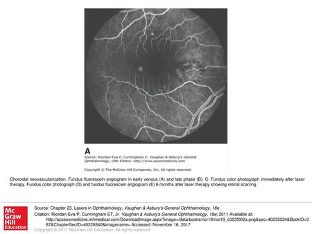 Choroidal neovascularization