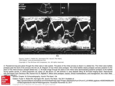 A. Parasternal long-axis plane through the mitral valve in late systole. The plane of the mitral annulus is drawn in a dotted line. The mitral valve leaflets.