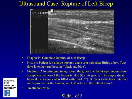 Ultrasound Case: Rupture of Left Bicep