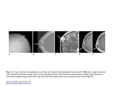 Fig. 5. A 13-year-old boy with epidermoid cyst of the skull