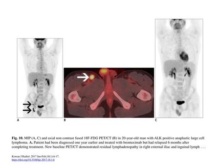 Fig. 10. MIP (A, C) and axial non contrast fused 18F-FDG PET/CT (B) in 20-year-old man with ALK positive anaplastic large cell lymphoma. A. Patient had.