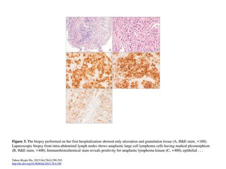 Figure 3. The biopsy performed on her first hospitalization showed only ulceration and granulation tissue (A, H&E stain, ×100). Laparoscopic biopsy from.