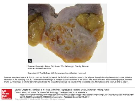 Invasive breast carcinoma