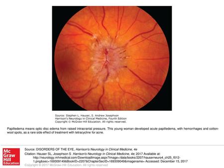 Papilledema means optic disc edema from raised intracranial pressure