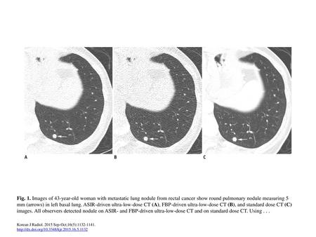 Fig. 1. Images of 43-year-old woman with metastatic lung nodule from rectal cancer show round pulmonary nodule measuring 5 mm (arrows) in left basal lung.