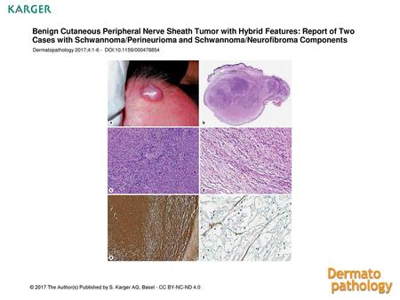 Benign Cutaneous Peripheral Nerve Sheath Tumor with Hybrid Features: Report of Two Cases with Schwannoma/Perineurioma and Schwannoma/Neurofibroma Components.