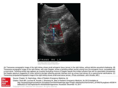 (A) Transverse sonographic image of the right kidney shows small echogenic focus (arrow) in the right kidney, without definite acoustical shadowing. (B)