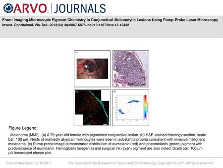 From: Imaging Microscopic Pigment Chemistry in Conjunctival Melanocytic Lesions Using Pump-Probe Laser Microscopy Invest. Ophthalmol. Vis. Sci.. 2013;54(10):6867-6876.