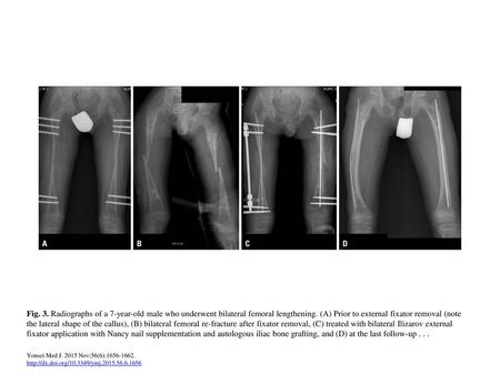 Fig. 3. Radiographs of a 7-year-old male who underwent bilateral femoral lengthening. (A) Prior to external fixator removal (note the lateral shape of.