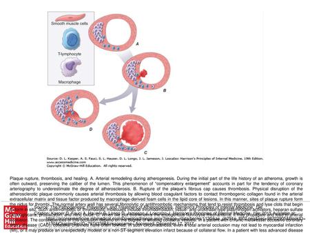 Plaque rupture, thrombosis, and healing. A