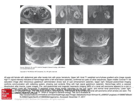 42-year-old female with abdominal pain after karate kick with gross hematuria. Upper left: Axial T1-weighted out-of-phase gradient echo image reveals high.