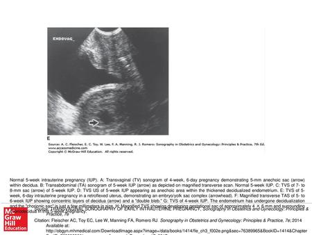 Normal 5-week intrauterine pregnancy (IUP)