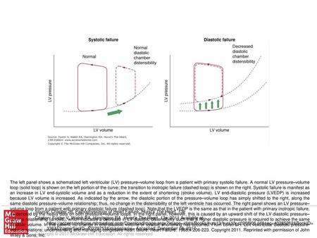 The left panel shows a schematized left ventricular (LV) pressure–volume loop from a patient with primary systolic failure. A normal LV pressure–volume.