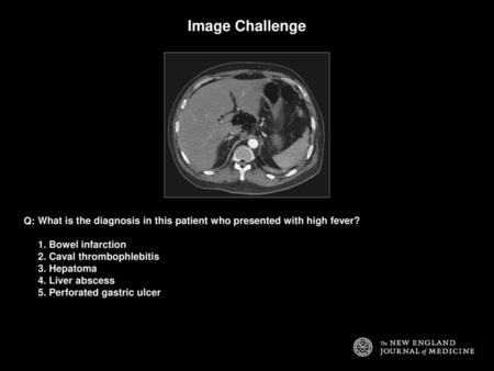 Image Challenge Q: What is the diagnosis in this patient who presented with high fever? 1. Bowel infarction 2. Caval thrombophlebitis 3. Hepatoma 4. Liver.