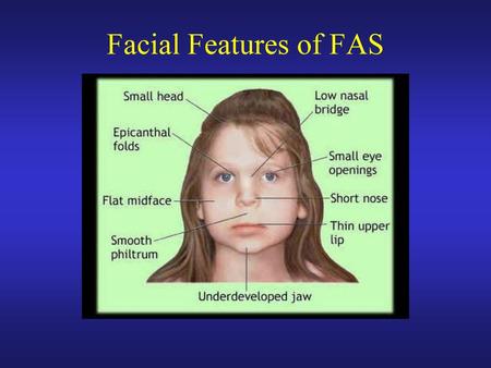 Facial Features of FAS.