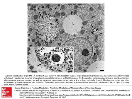 Liver cell ultrastructure of girl M. S