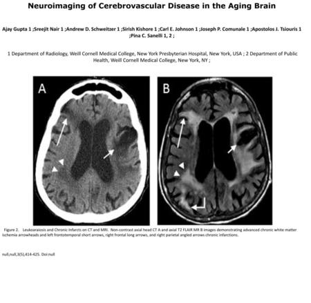 Neuroimaging of Cerebrovascular Disease in the Aging Brain