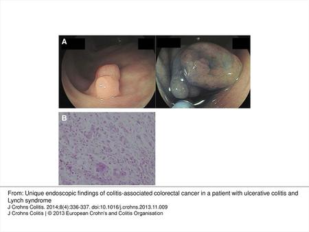 Figure 1 (A): The 0-Isp polyp mimicking inflammatory polyp was found at hepatic flexure. The top surface of the polyp was depressed. (B): Hematoxylin stain.