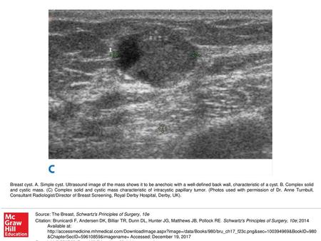 Breast cyst. A. Simple cyst