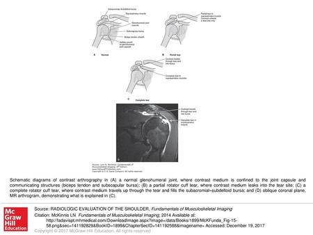 Schematic diagrams of contrast arthrography in (A) a normal glenohumeral joint, where contrast medium is confined to the joint capsule and communicating.