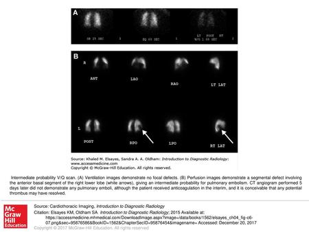 Intermediate probability V/Q scan