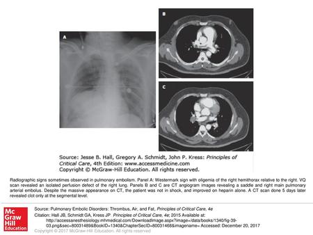 Radiographic signs sometimes observed in pulmonary embolism